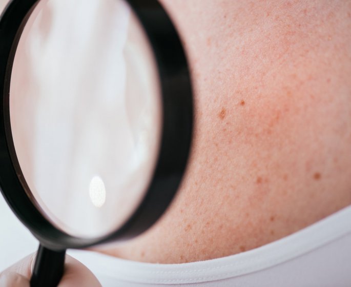 Prevention du melanome : proteger et surveiller sa peau