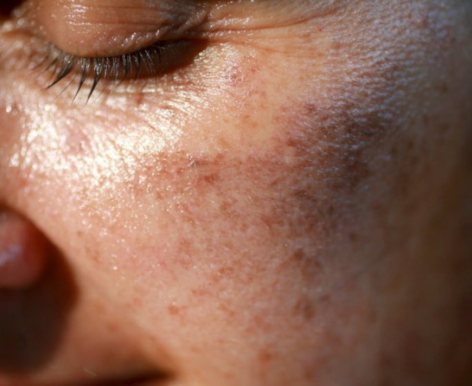 Taches brunes : l-astuce d-un chirurgien esthetique pour les eviter