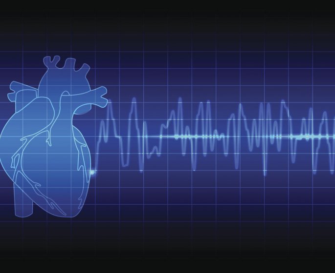 Infarctus chez la femme : le diagnostic par electrocardiogramme