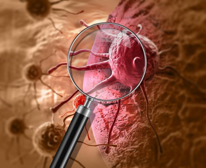 XGEVA® : risque de second cancer avec ce medicament 