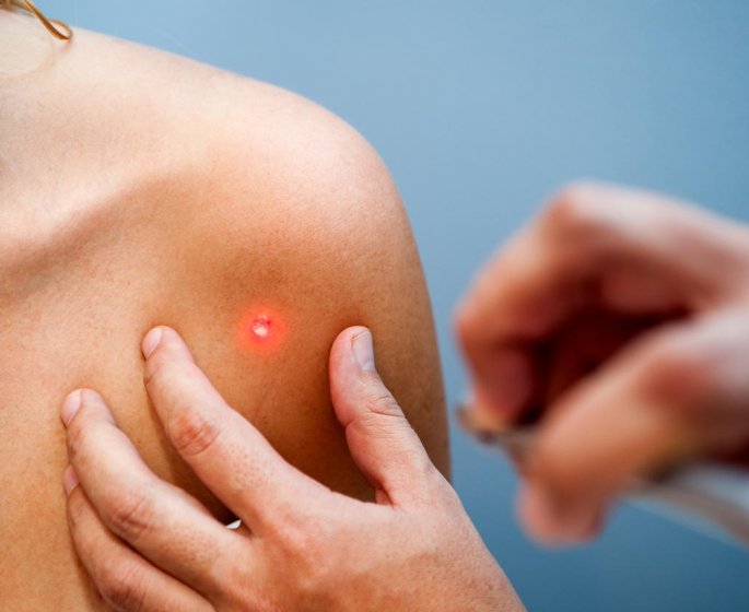 Grain de beaute rouge : un signe de cancer de la peau ?