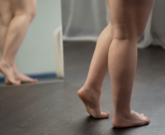 Maladie des jambes poteaux : 1 femme sur 10 souffre du lipoedeme en France