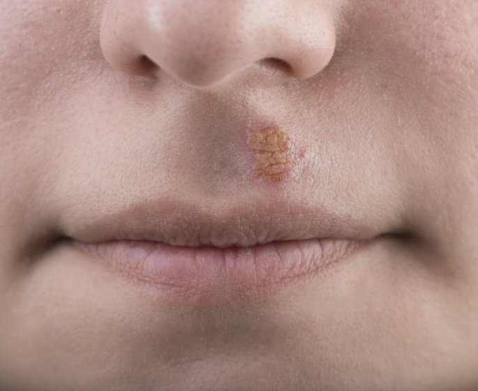 Bouton de fievre : le soigner avec de l-homeopathie