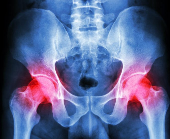 Rhume de hanche chez l-adulte, l-enfant : comment le soigner ?