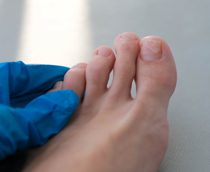 "J-ai des lignes blanches sur mes ongles de pieds. Dois-je m-inquieter ?"