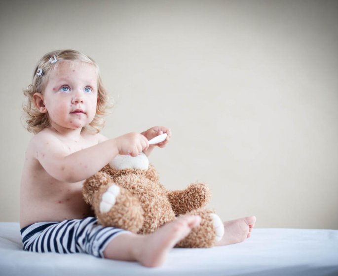 Rougeole : quels sont les risques pour la sante de bebe