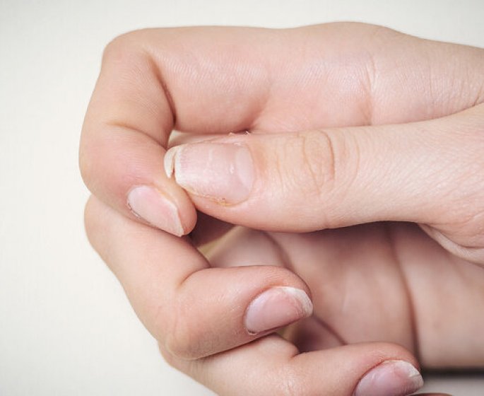Pourquoi mes ongles se dedoublent ?
