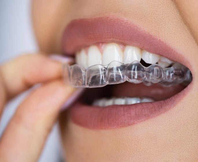 Eclaircissement dentaire : ce qu’il faut savoir sur ce "lifting des dents"