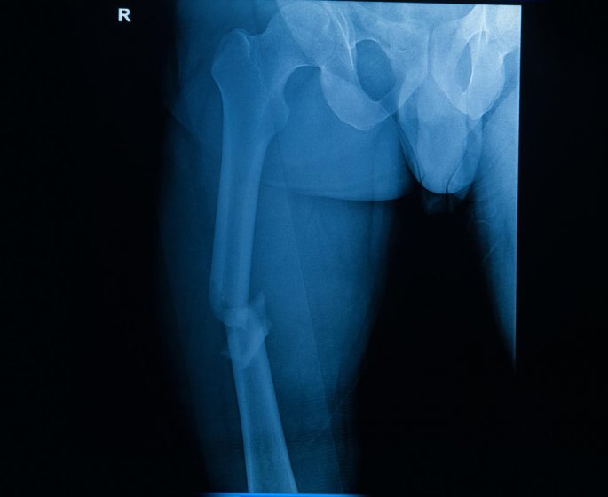 Fracture de fatigue (ou de stress) pied, tibia, talon : comment la soigner ? 