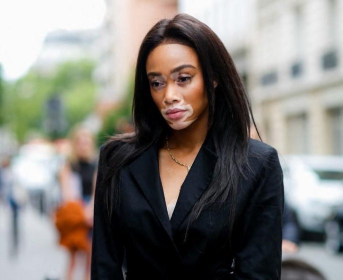 Bientot une creme pour soigner le vitiligo