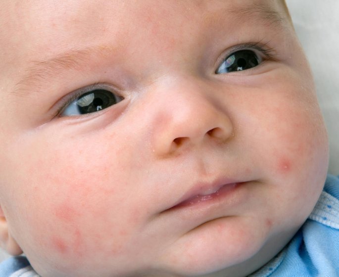 Acne du nourrisson : comment le reconnaitre ?