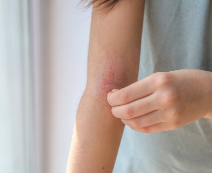 Quiz : connaissez-vous vraiment l’eczema ?