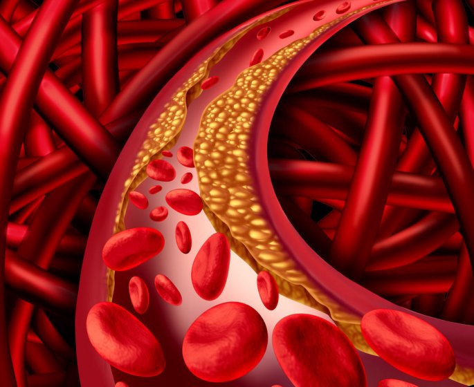 Troubles erectiles : l-atherosclerose en cause ?