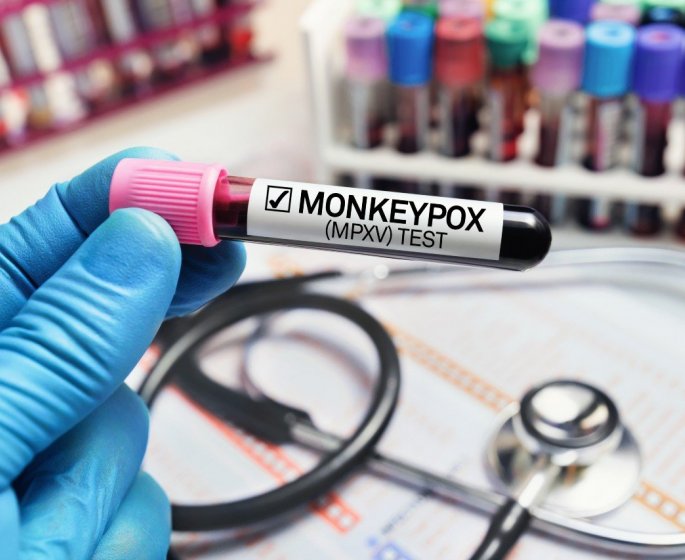 Variole du singe : que sait-on des 5 premiers deces hors d-Afrique ?