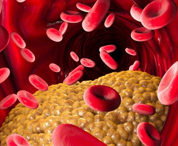 Triglycerides eleves : les aliments a eviter