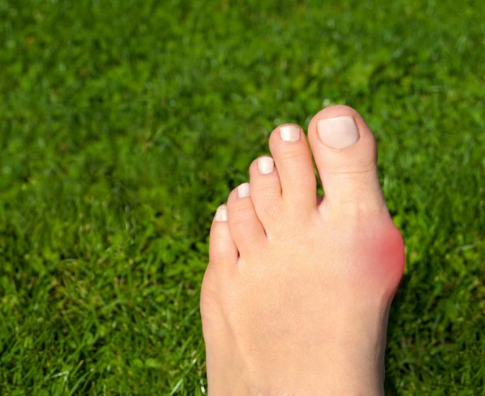Pieds : comment en finir avec les oignons !