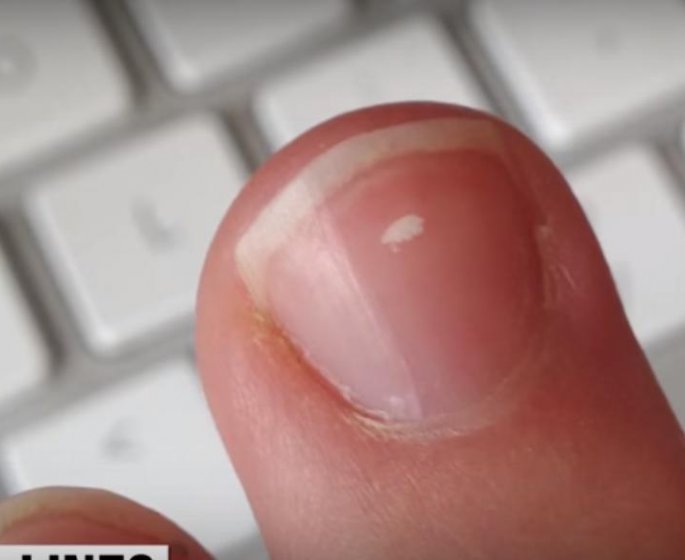 Pourquoi vous avez des taches blanches sur les ongles