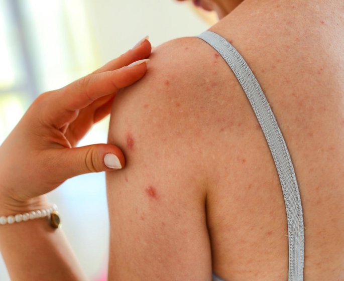 Piqure de frelon europeen : que faire en cas d-allergie