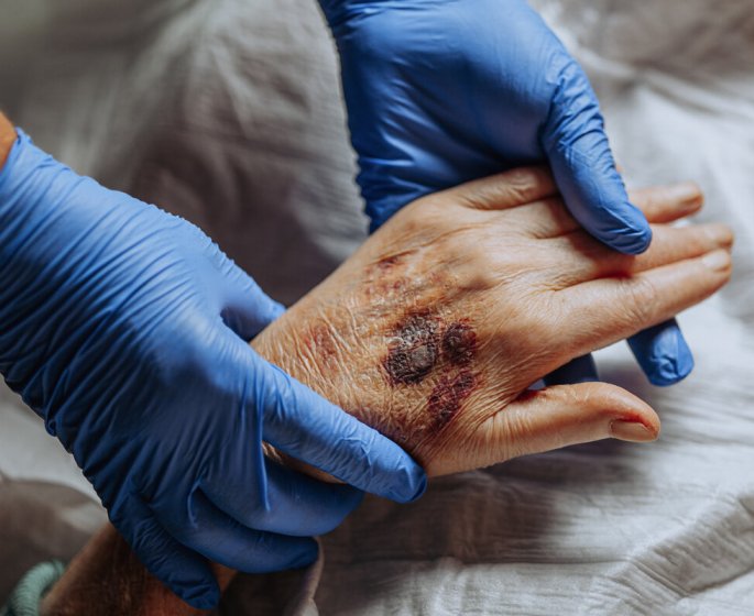 Arthrite : de faibles niveaux de testosterone pourraient l’accentuer