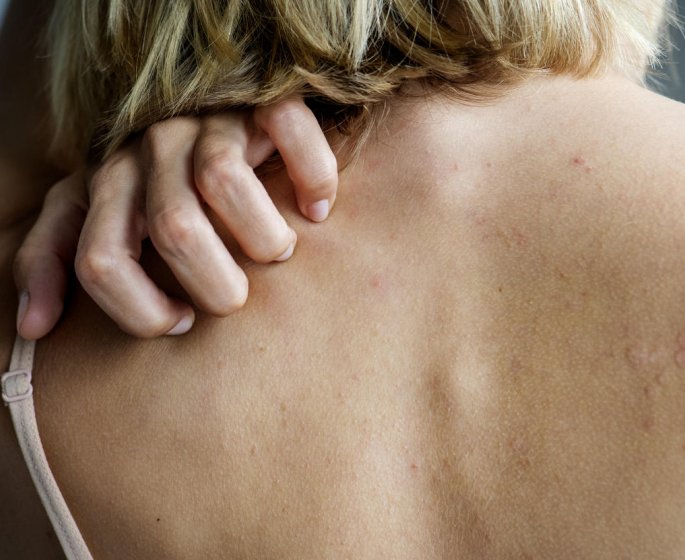 Quels sont les symptomes de la gale ?