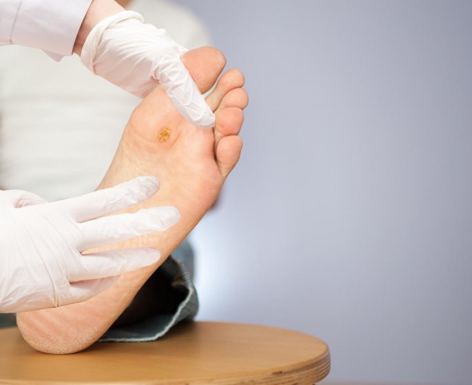 Verrue plantaire : comment savoir si elle est morte ?