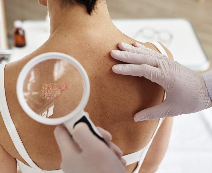 Une enquete revele les difficultes d’acces aux soins des Francais atteints de psoriasis