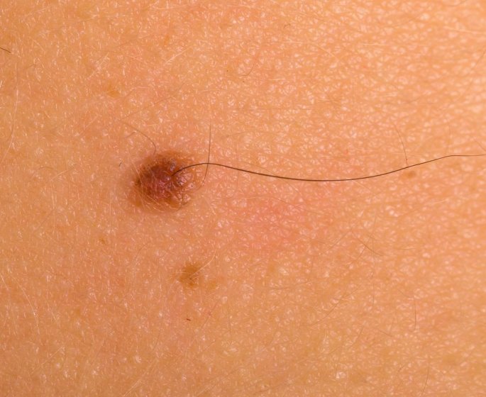 Poils sur un grain de beaute : est-il dangereux de les arracher ?