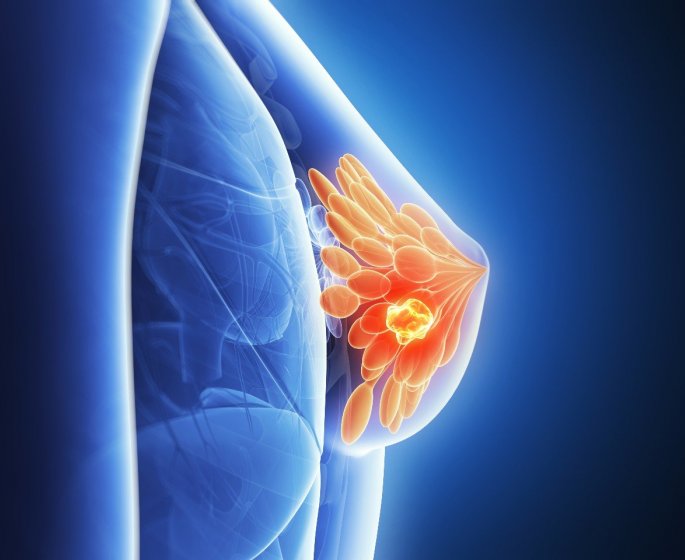 Cancer triple negatif : qu-est-ce que c-est ?