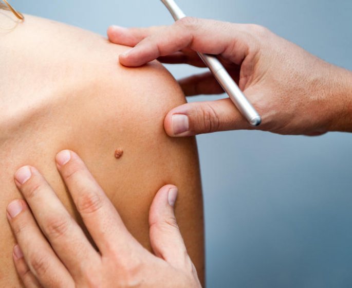 Cancer : le nombre de grains de beaute qui vous rend a risque