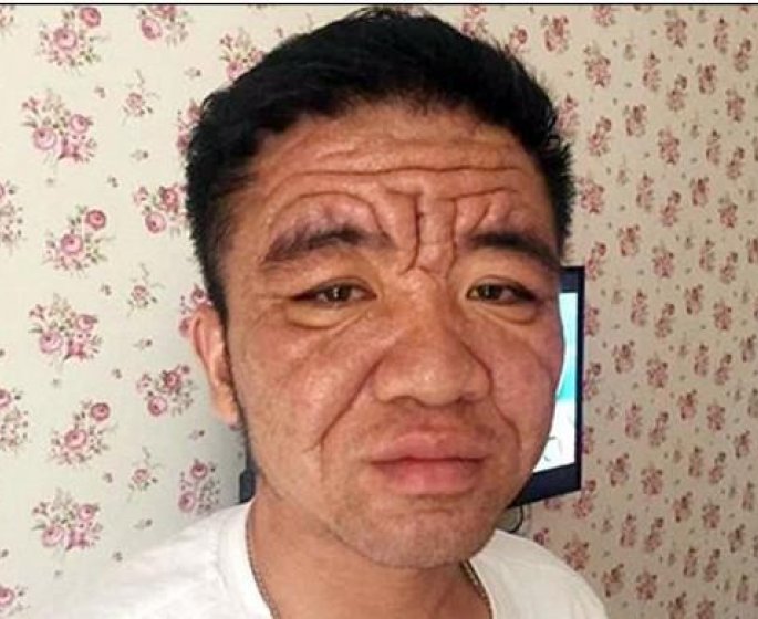A cause d-une maladie mysterieuse, il a le visage d-un vieillard