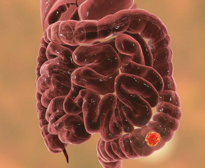 Pourquoi le surpoids augmente le risque de cancer du colon