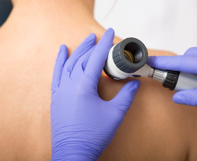 Cancer de la peau : quels sont les signes d’alerte ? 