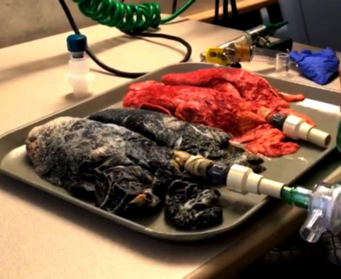 La video choc d’une infirmiere qui a filme les poumons malades d’un fumeur decede 