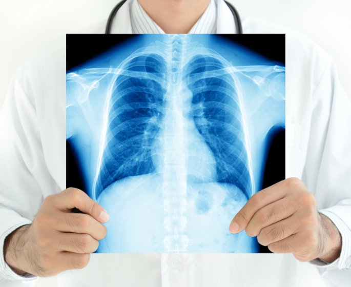 Cancer du poumon : les details du depistage