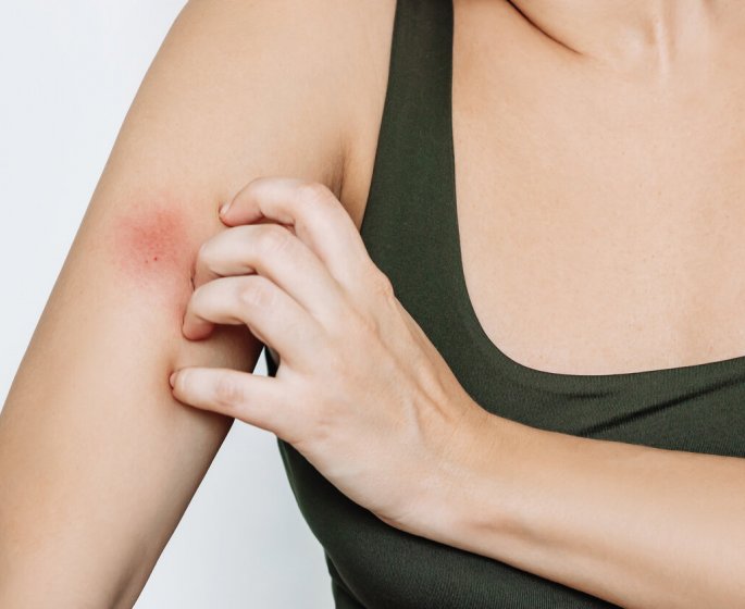 Recrudescence des piqures de taon : "Mon medecin m-a donne ces conseils"
