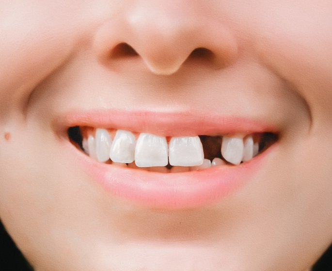 Osteoporose : les medicaments vous font-ils vraiment perdre vos dents ?