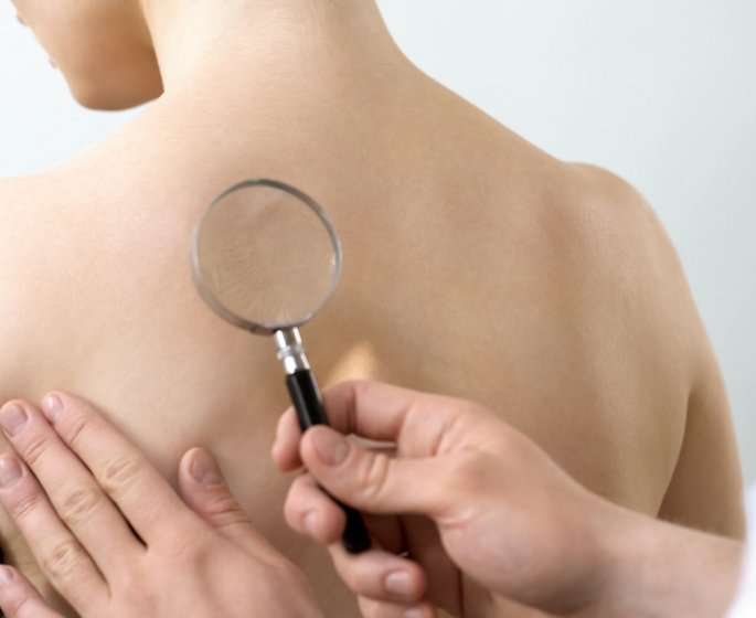 Cancer de la peau : avoir eu plus de 10 partenaires sexuels augmente vos risques !