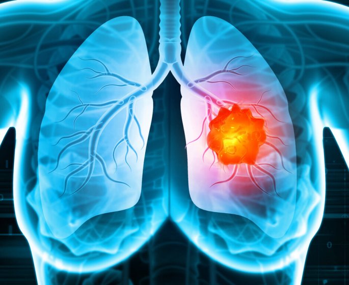 Cancer du poumon : ces vitamines favorisent son developpement