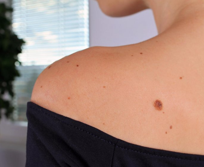 Lentigo solaire : comment le reconnaitre chez l-enfant ?