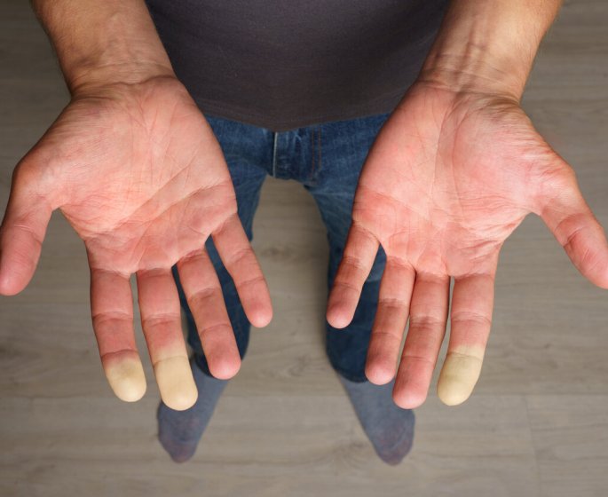 Vous avez souvent les mains froides ? Faites le test pour savoir si c’est la maladie de Raynaud