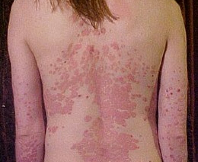 Reconnaitre le psoriasis du dos et des fesses