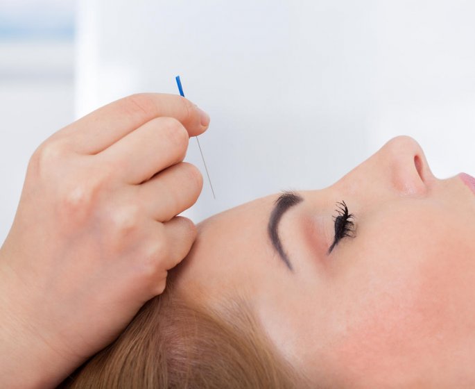 Cephalees : l-acupuncture, traitement miracle contre les maux de tete ? 