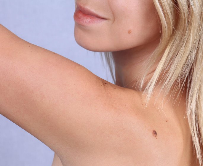 Verrue seborrheique ou melanome : la difference