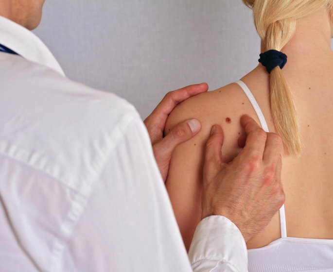 Cancer de la peau : depistage, facteurs de risque et traitements