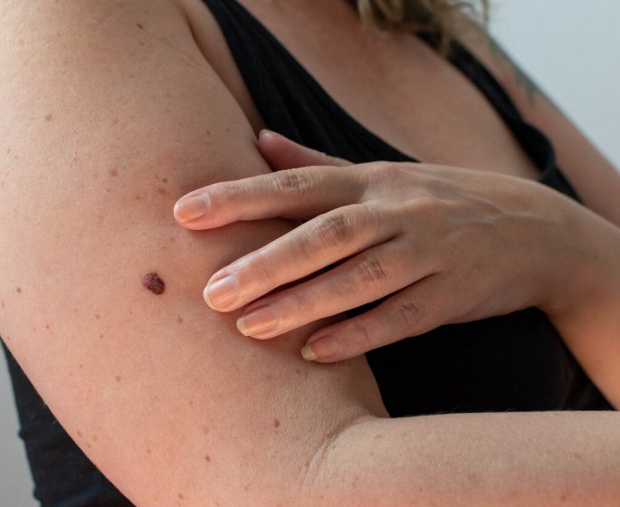 La methode ABCDE pour surveiller vos grains de beaute !