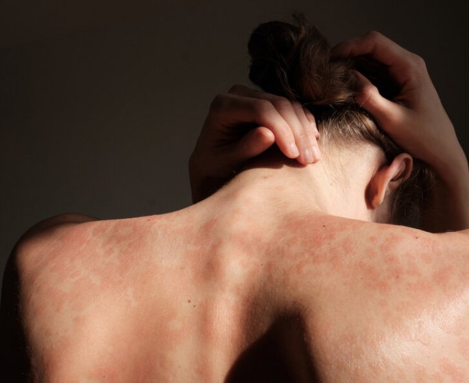 Le psoriasis est-il une maladie psychosomatique ?
