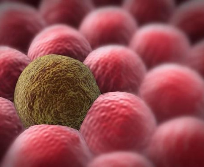 Cancer : symptomes, causes, traitement, taux de survie 