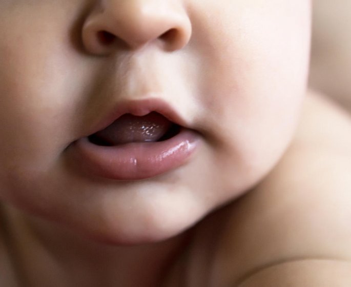 4 remedes contre les aphtes chez le bebe