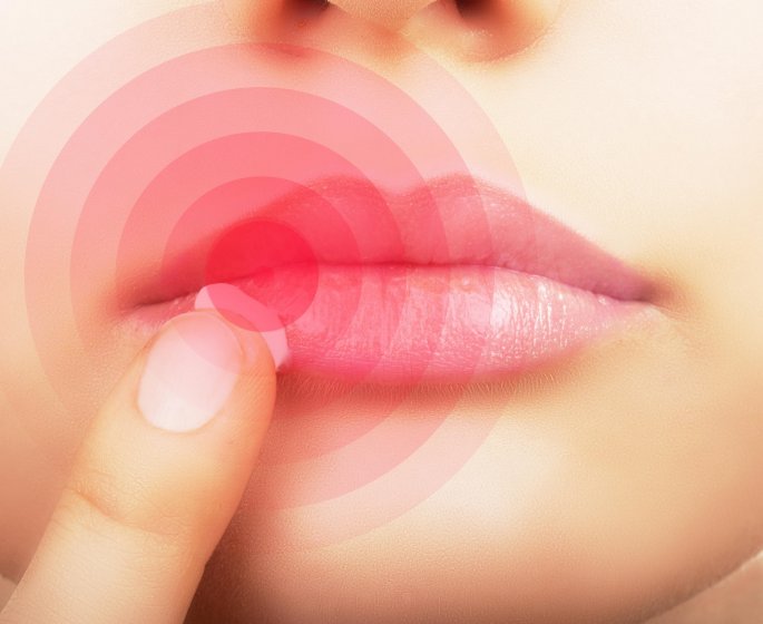 Herpes : l-herpes buccal, c-est quoi ?