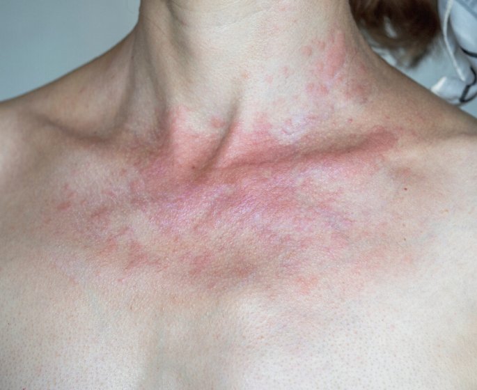 Lucite, urticaires… Quelles sont les causes des allergies au soleil ?
